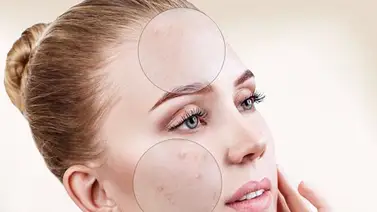 Claves para eliminar manchas del rostro Claves para eliminar manchas del rostro