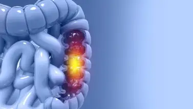 Aprueban rápido método para detectar el cáncer de colon: sepa cuál Aprueban rápido método para detectar el cáncer de colon: sepa cuál